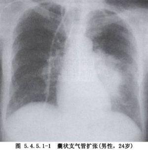 支气管扩张最新治疗方案，探索、理解与应用