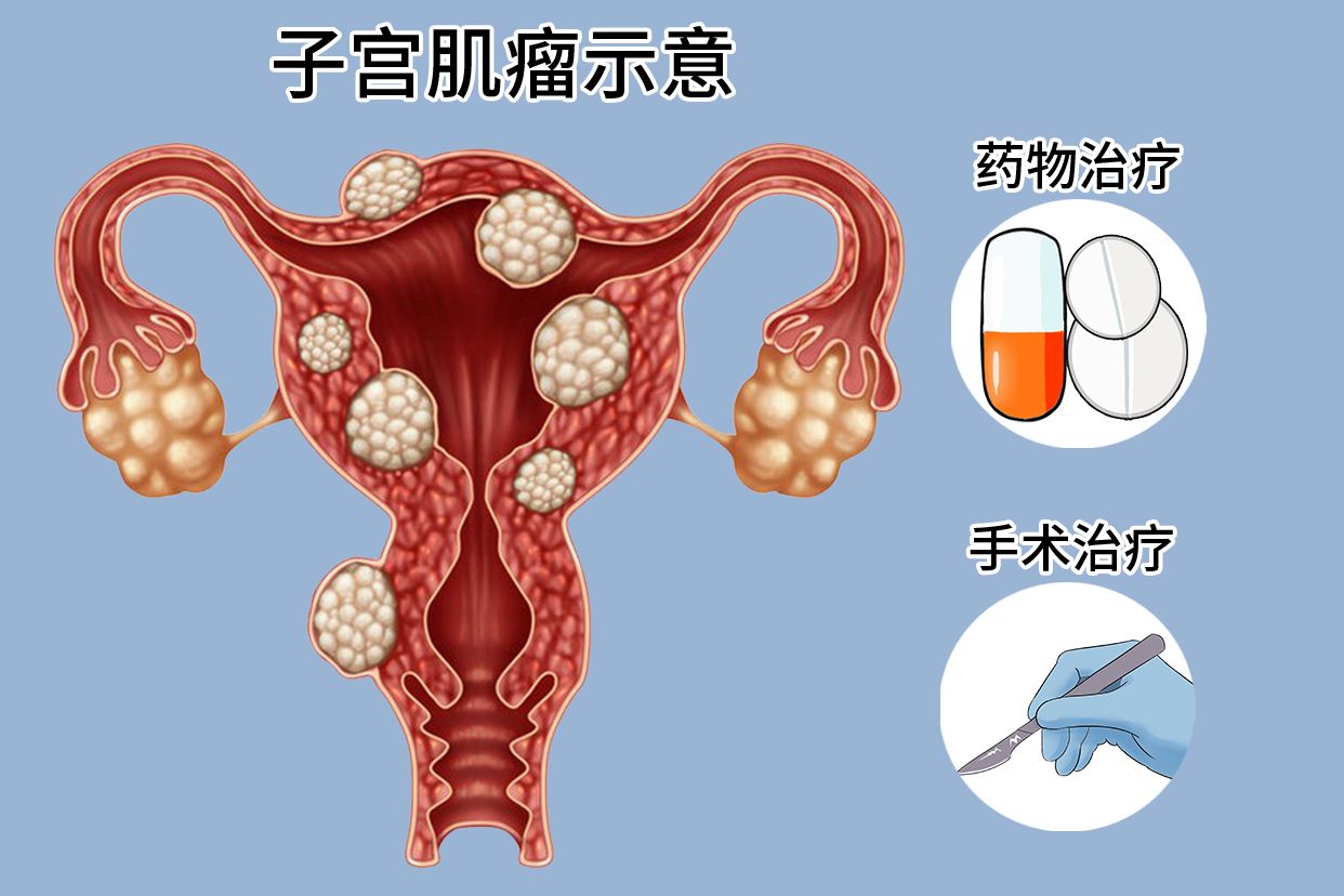 子宫腺肌瘤最新最佳治疗方法解析