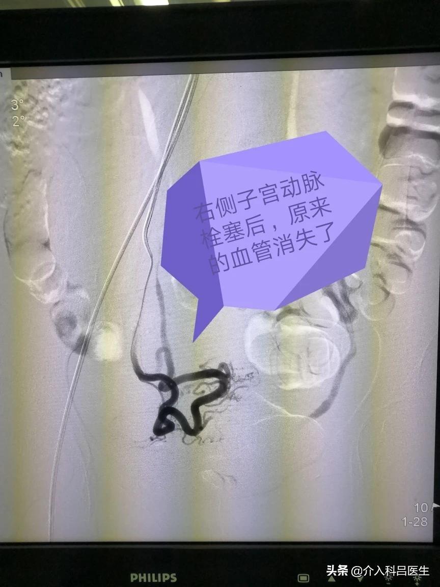 腺肌症最新治疗技术与方法探索